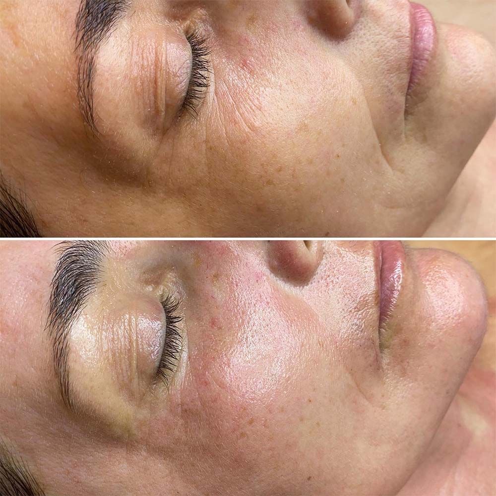 Regeneracja anti-aging